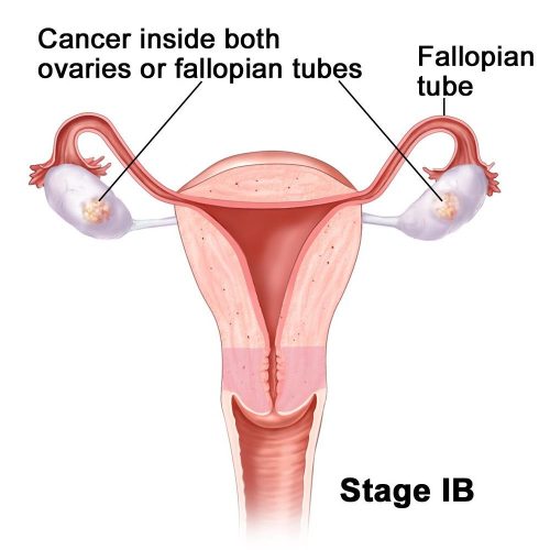 Stage 1B Ovarian Cancer