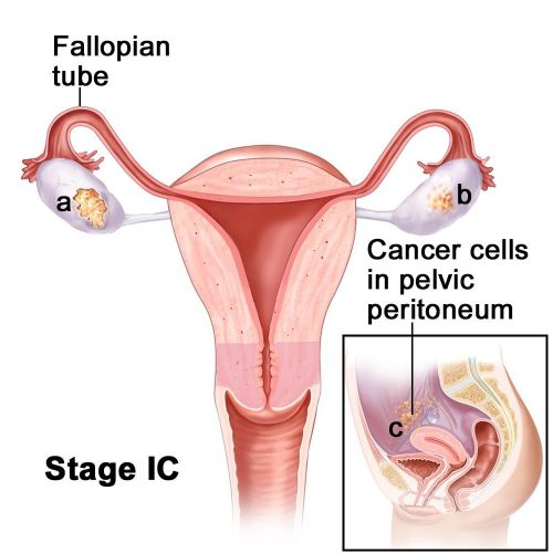 Stage 1C Ovarian Cancer