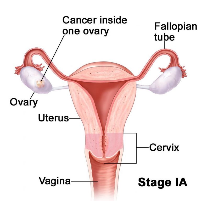 Stage 1A Ovarian Cancer